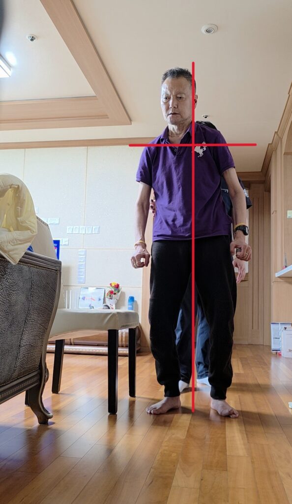 재활 전 자세 · 중심선 기준 우측으로 기울어짐 · 어깨 높이 차이 큼
