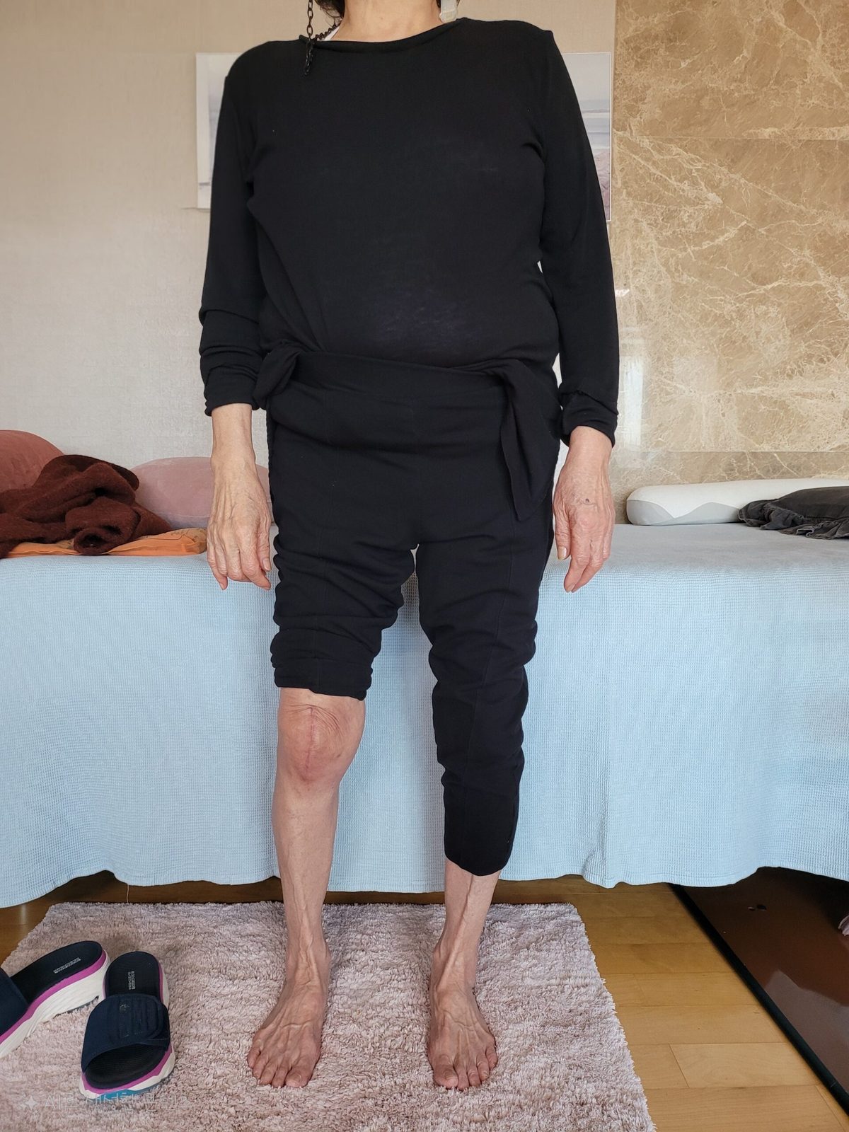 무릎 인공관절 수술 후 재활 사례(2)