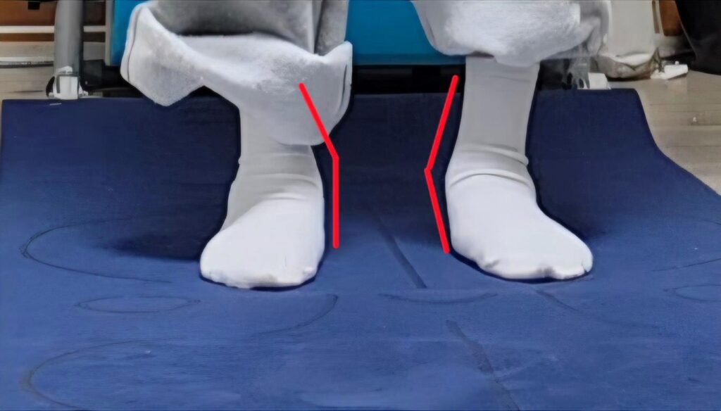 발의 아치가 무너져 내린 상태 (평발)