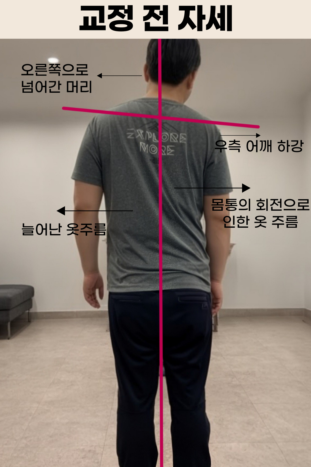 요추 염좌 통증완화 및 체형교정 재활 사례