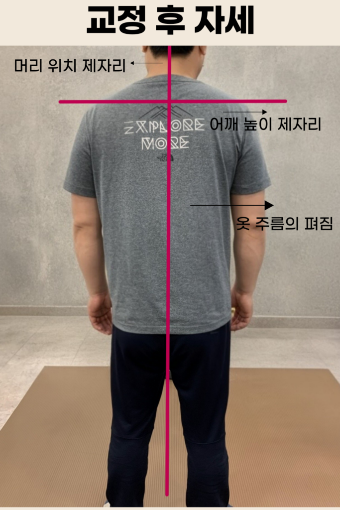 요추 염좌 통증완화 및 체형교정 재활 교정 장면